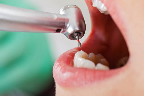 Best Lost Filling or Crown Replacement in Lena, IL